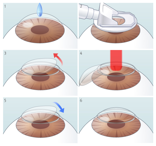 라식 수술 Laser In-situ Keratomileusis, LASIK